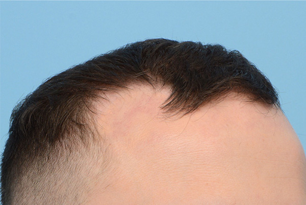 Fue Before and After | Dr. Jeffrey Wise