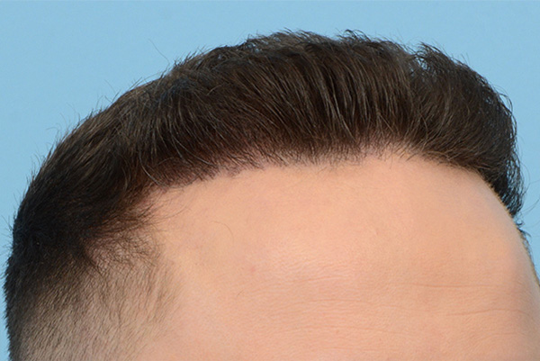 Fue Before and After | Dr. Jeffrey Wise