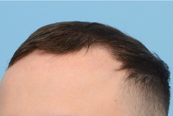 Fue Before and After | Dr. Jeffrey Wise