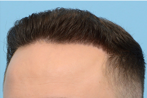 Fue Before and After | Dr. Jeffrey Wise