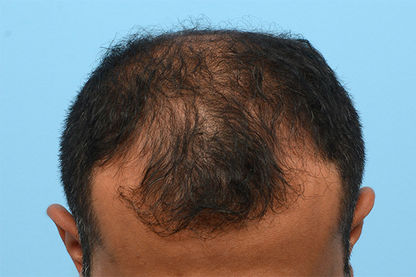 Fue Before and After | Dr. Jeffrey Wise