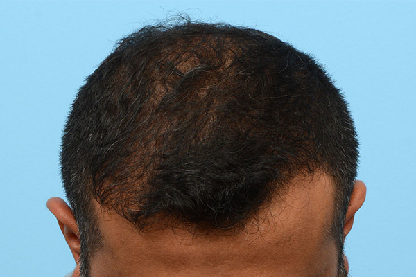 Fue Before and After | Dr. Jeffrey Wise