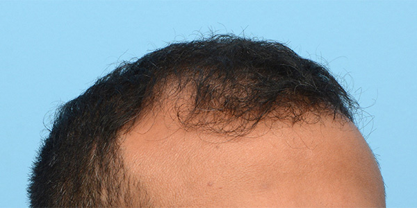 Fue Before and After | Dr. Jeffrey Wise