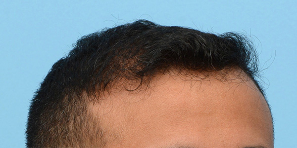 Fue Before and After | Dr. Jeffrey Wise