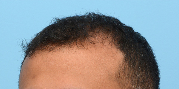 Fue Before and After | Dr. Jeffrey Wise