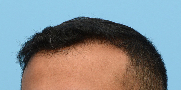 Fue Before and After | Dr. Jeffrey Wise