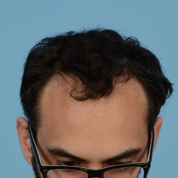 Fue Before and After | Dr. Jeffrey Wise