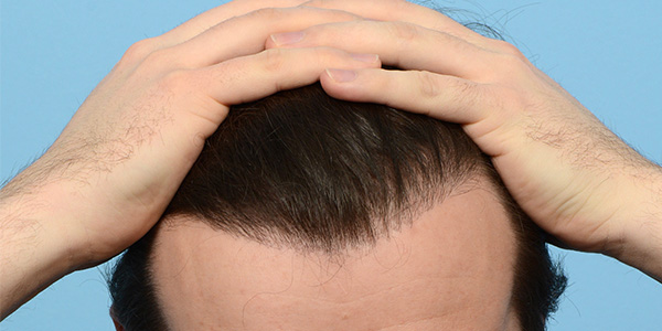 Fue Before and After | Dr. Jeffrey Wise