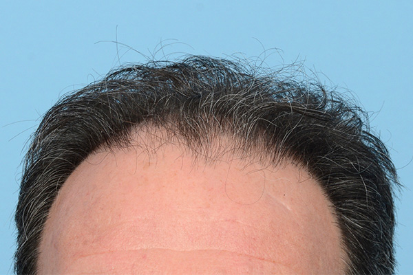 Fue Before and After | Dr. Jeffrey Wise