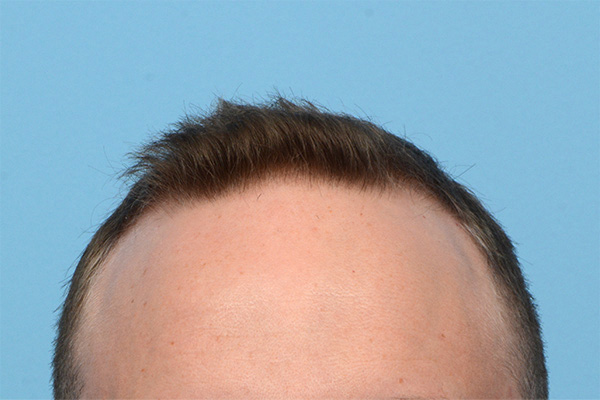 Fue Before and After | Dr. Jeffrey Wise