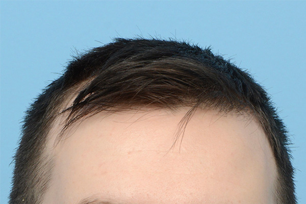 Fue Before and After | Dr. Jeffrey Wise