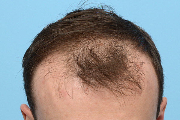 Fue Before and After | Dr. Jeffrey Wise