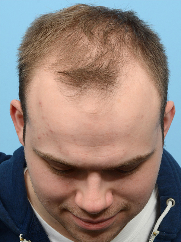 Fue Before and After | Dr. Jeffrey Wise