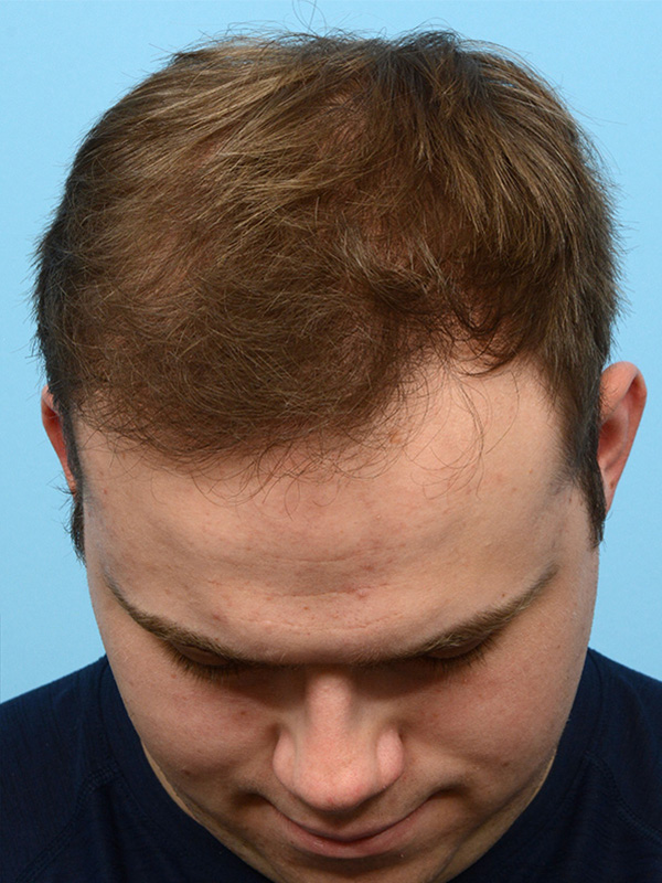 Fue Before and After | Dr. Jeffrey Wise