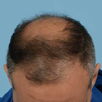 Fue Before and After | Dr. Jeffrey Wise