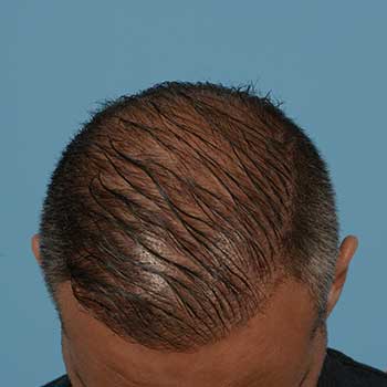 Fue Before and After | Dr. Jeffrey Wise