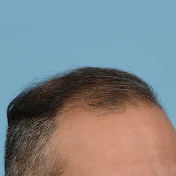 Fue Before and After | Dr. Jeffrey Wise