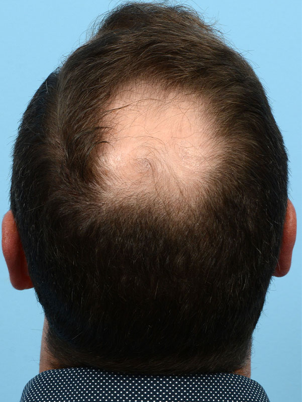 Fue Before and After | Dr. Jeffrey Wise