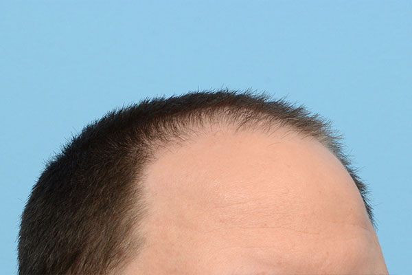 Fue Before and After | Dr. Jeffrey Wise