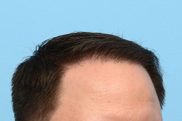 Fue Before and After | Dr. Jeffrey Wise