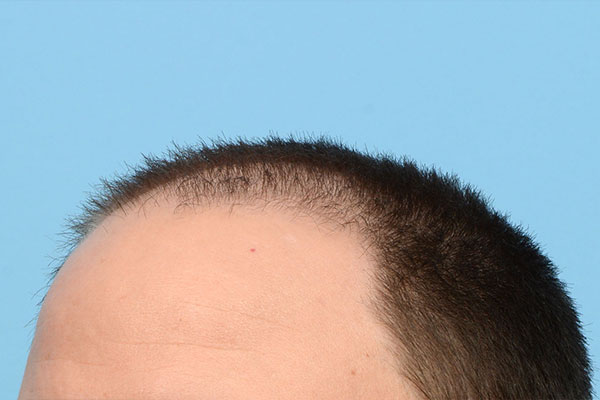 Fue Before and After | Dr. Jeffrey Wise