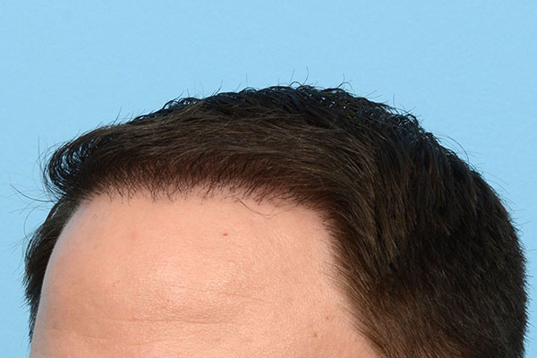 Fue Before and After | Dr. Jeffrey Wise