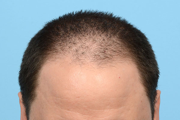 Fue Before and After | Dr. Jeffrey Wise