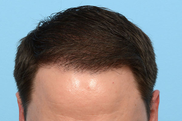 Fue Before and After | Dr. Jeffrey Wise