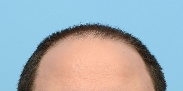 Fue Before and After | Dr. Jeffrey Wise