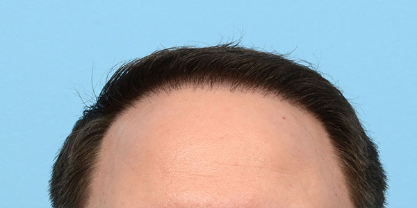 Fue Before and After | Dr. Jeffrey Wise