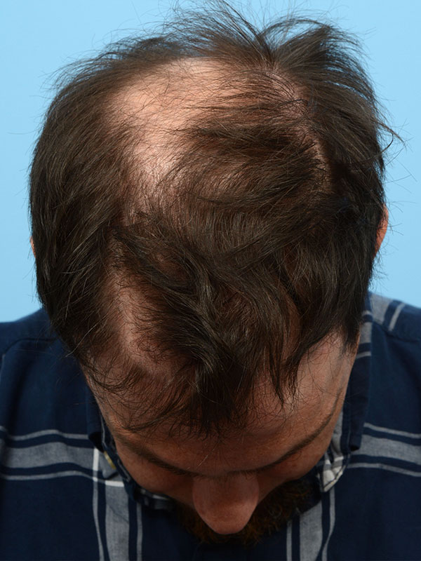 Fue Before and After | Dr. Jeffrey Wise