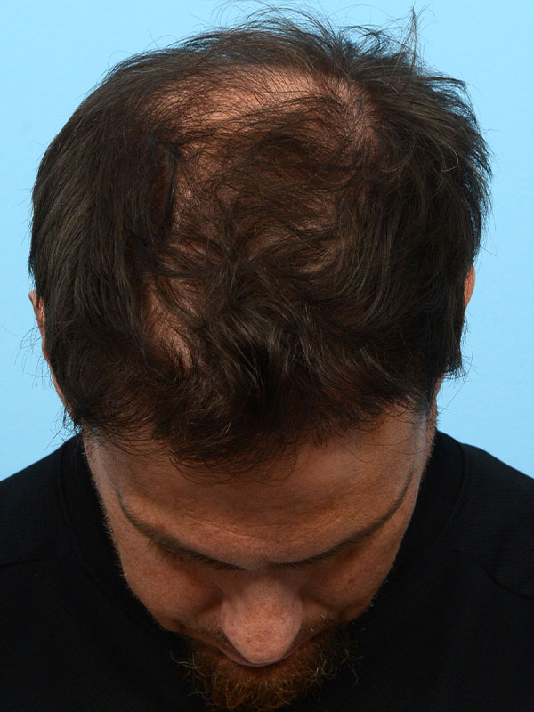 Fue Before and After | Dr. Jeffrey Wise