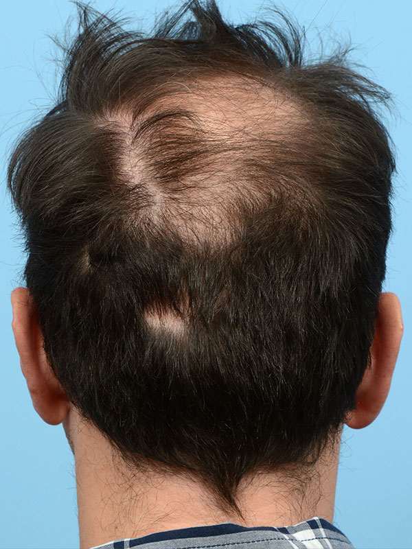 Fue Before and After | Dr. Jeffrey Wise