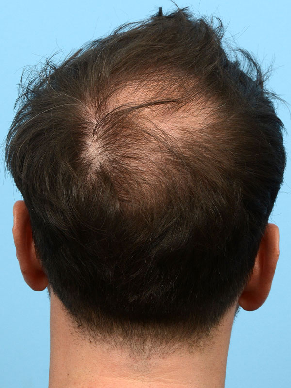 Fue Before and After | Dr. Jeffrey Wise