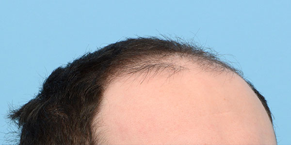 Fue Before and After | Dr. Jeffrey Wise