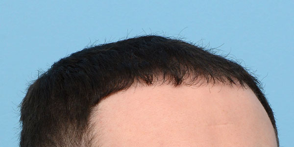 Fue Before and After | Dr. Jeffrey Wise