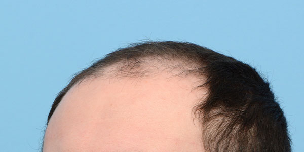 Fue Before and After | Dr. Jeffrey Wise