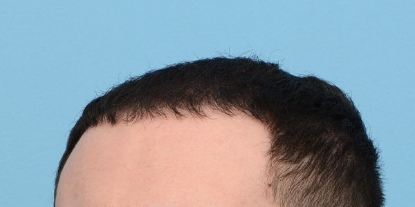 Fue Before and After | Dr. Jeffrey Wise