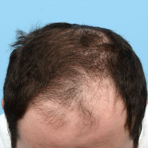 Fue Before and After | Dr. Jeffrey Wise