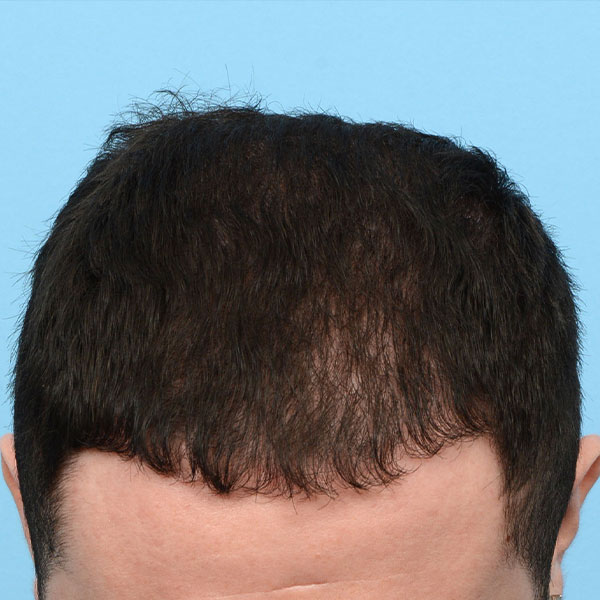 Fue Before and After | Dr. Jeffrey Wise