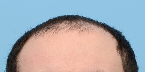 Fue Before and After | Dr. Jeffrey Wise