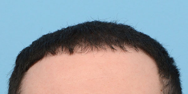 Fue Before and After | Dr. Jeffrey Wise