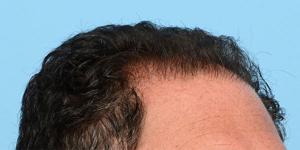 Fue Before and After | Dr. Jeffrey Wise