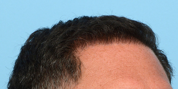 Fue Before and After | Dr. Jeffrey Wise