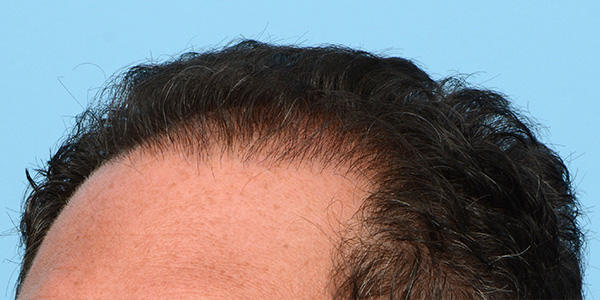 Fue Before and After | Dr. Jeffrey Wise