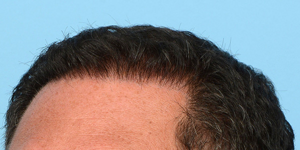 Fue Before and After | Dr. Jeffrey Wise