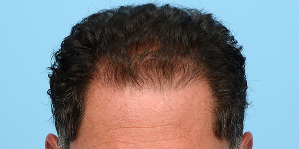 Fue Before and After | Dr. Jeffrey Wise