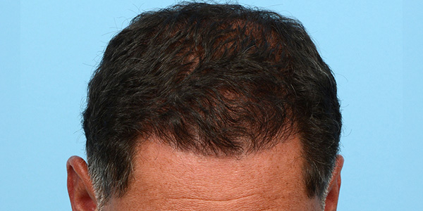 Fue Before and After | Dr. Jeffrey Wise