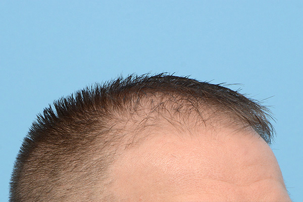 Fue Before and After | Dr. Jeffrey Wise