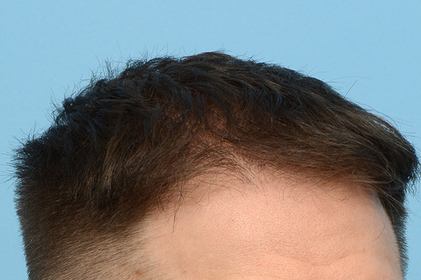 Fue Before and After | Dr. Jeffrey Wise